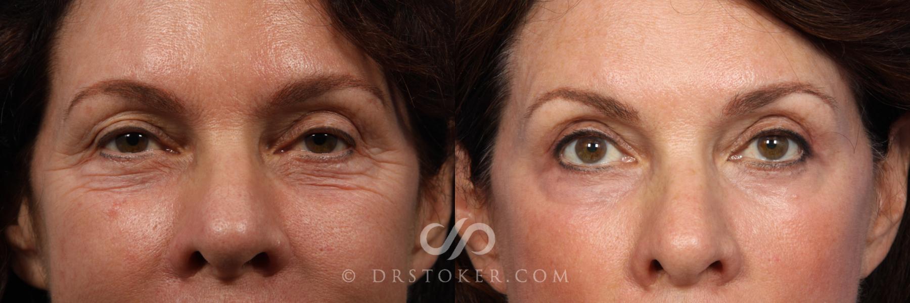 Before & After Eyelid Surgery Case 419 View #1 View in Los Angeles, CA