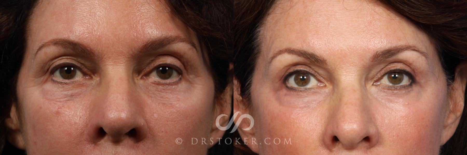 Before & After Laser Skin Resurfacing Case 419 View #2 View in Los Angeles, CA