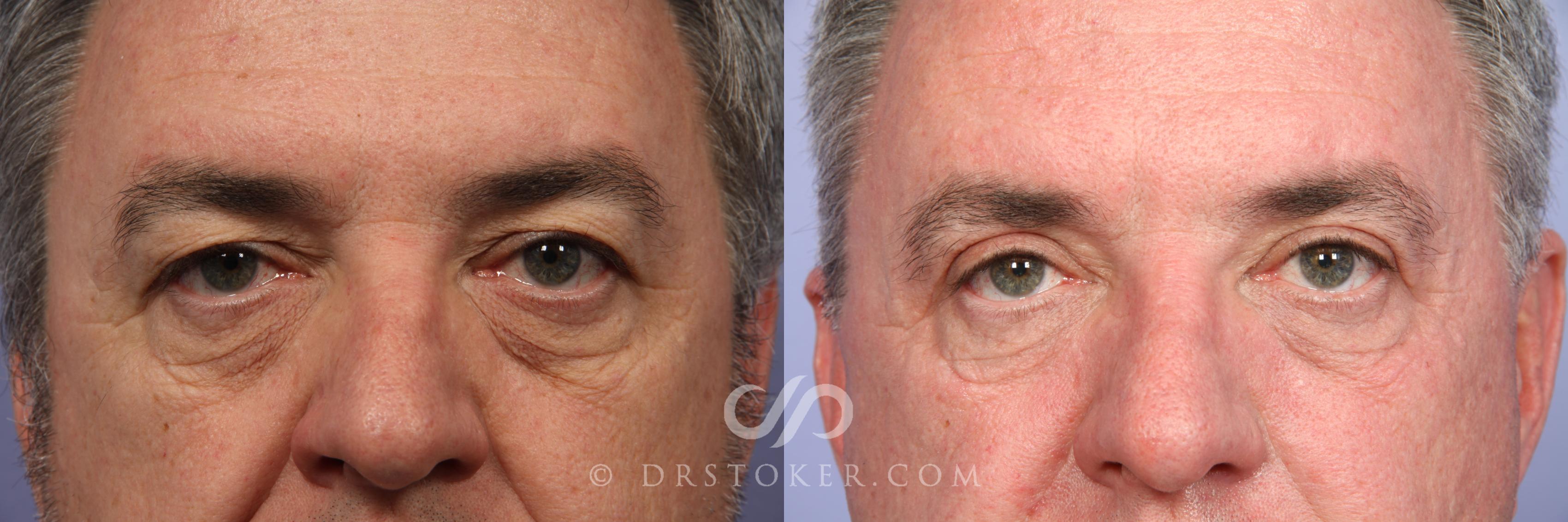 Before & After Eyelid Surgery for Men Case 489 View #1 View in Marina del Rey, CA