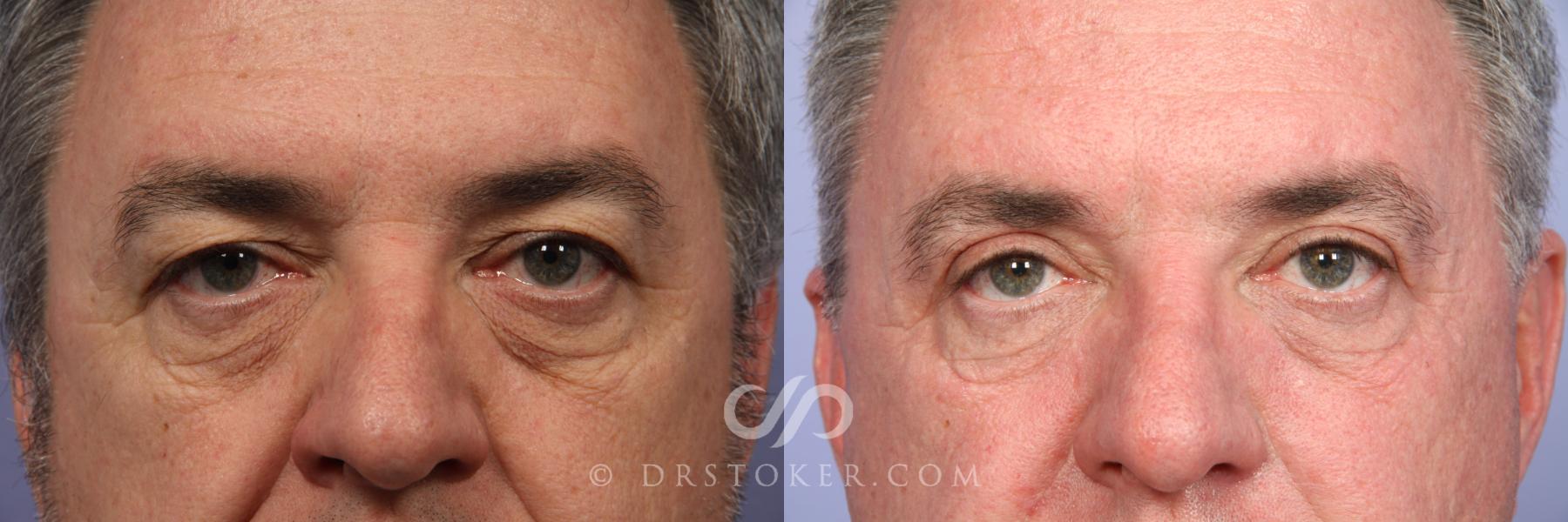Before & After Eyelid Surgery Case 489 View #1 View in Los Angeles, CA