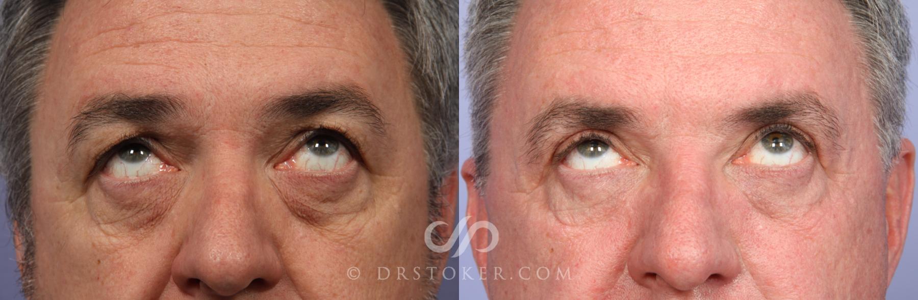 Before & After Laser Skin Resurfacing Case 489 View #2 View in Los Angeles, CA