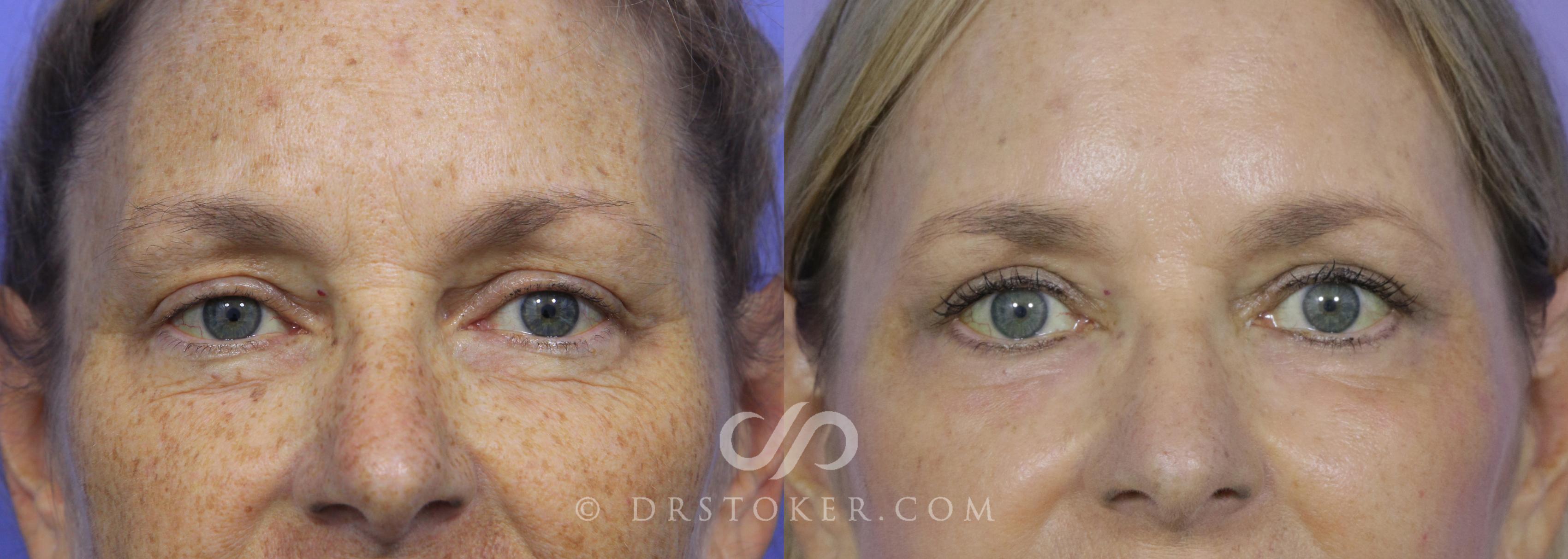 Before & After Eyelid Surgery Case 540 View #1 View in Los Angeles, CA