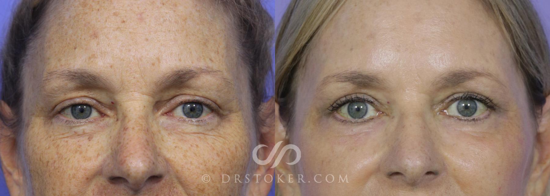 Before & After Laser Skin Resurfacing Case 540 View #1 View in Los Angeles, CA
