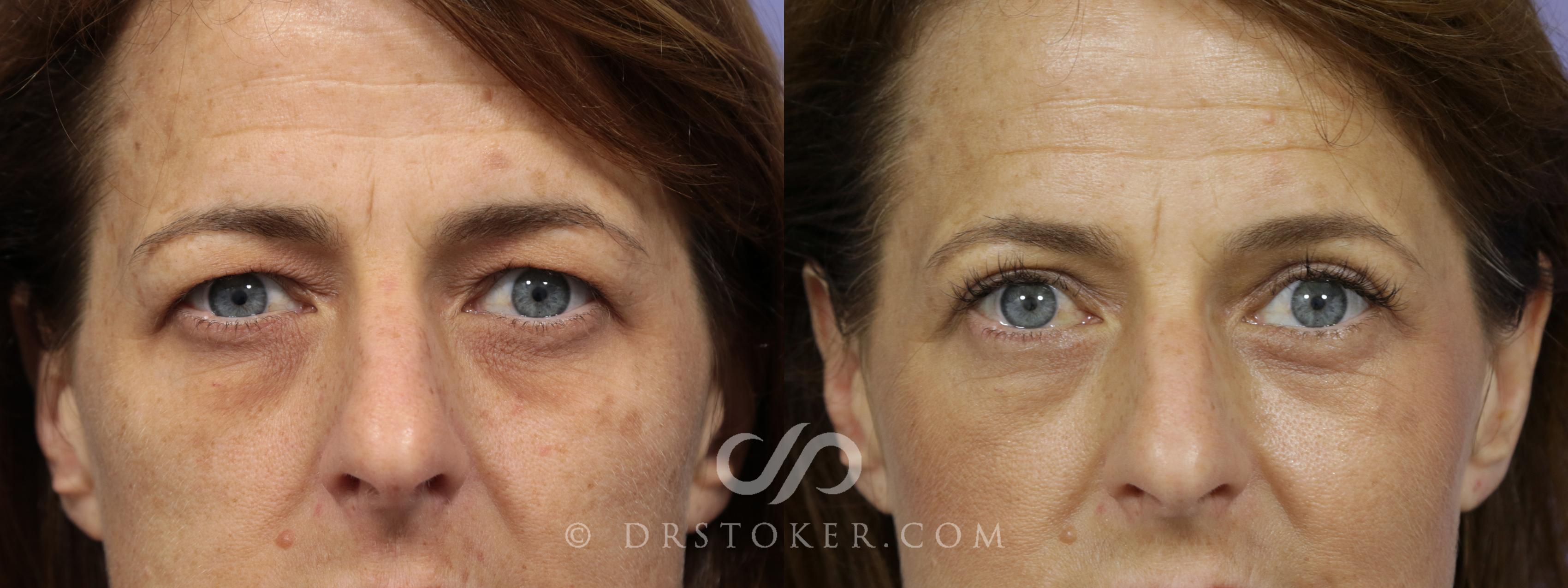 Before & After Eyelid Surgery Case 838 View #1 View in Los Angeles, CA