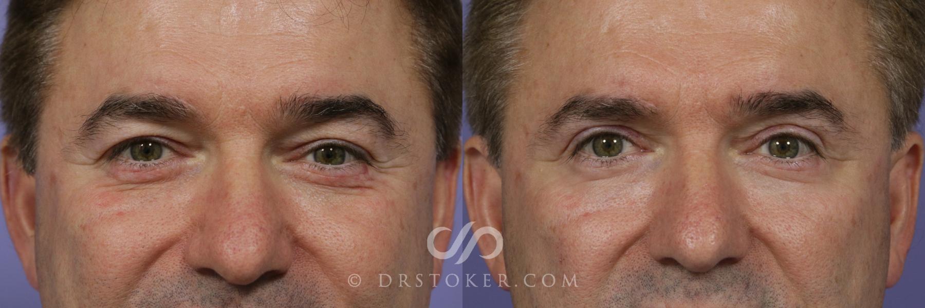Before & After Eyelid Surgery for Men Case 839 View #1 View in Los Angeles, CA