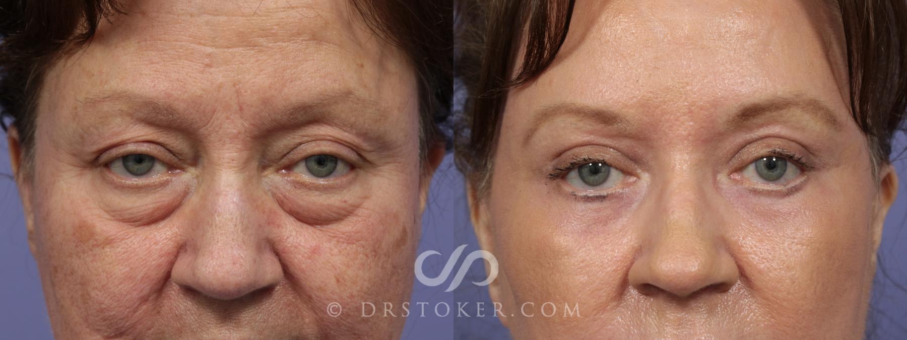 Before & After Eyelid Surgery Case 840 View #1 View in Los Angeles, CA