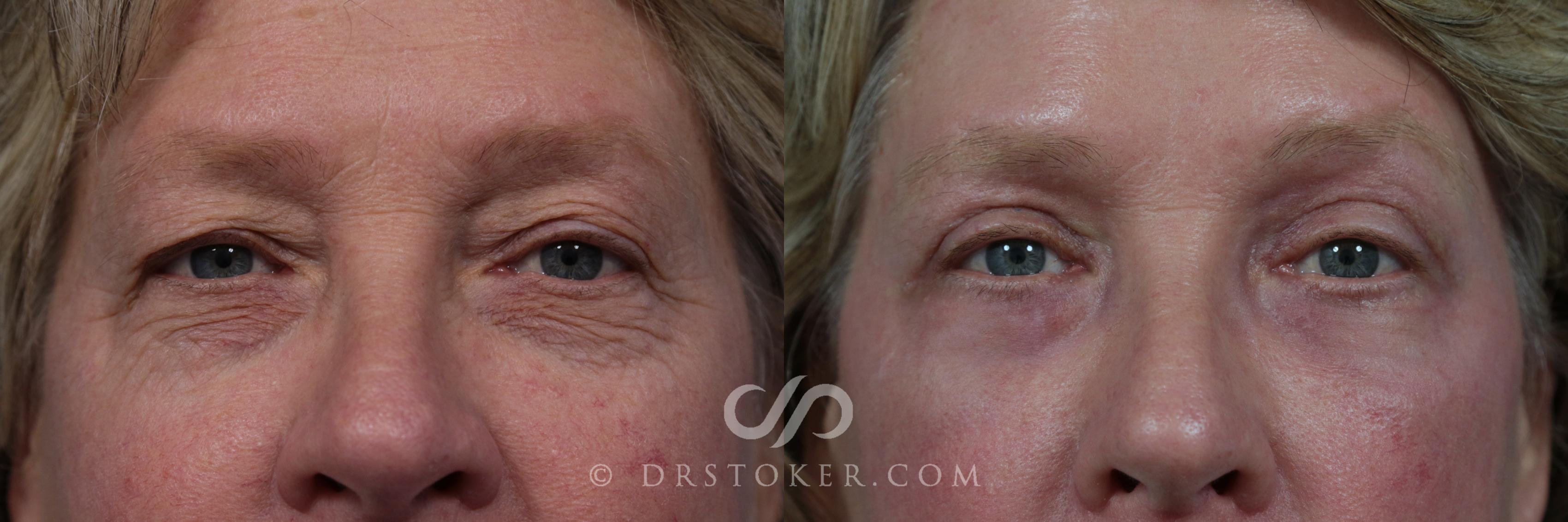 Before & After Eyelid Surgery Case 841 View #1 View in Los Angeles, CA