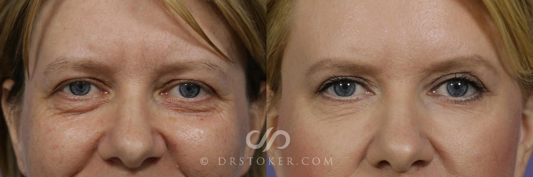 Before & After Eyelid Surgery Case 842 View #1 View in Los Angeles, CA