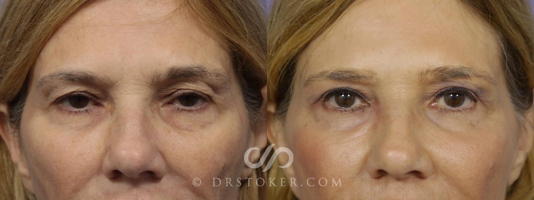 Before & After Eyelid Surgery Case 843 View #1 View in Los Angeles, CA