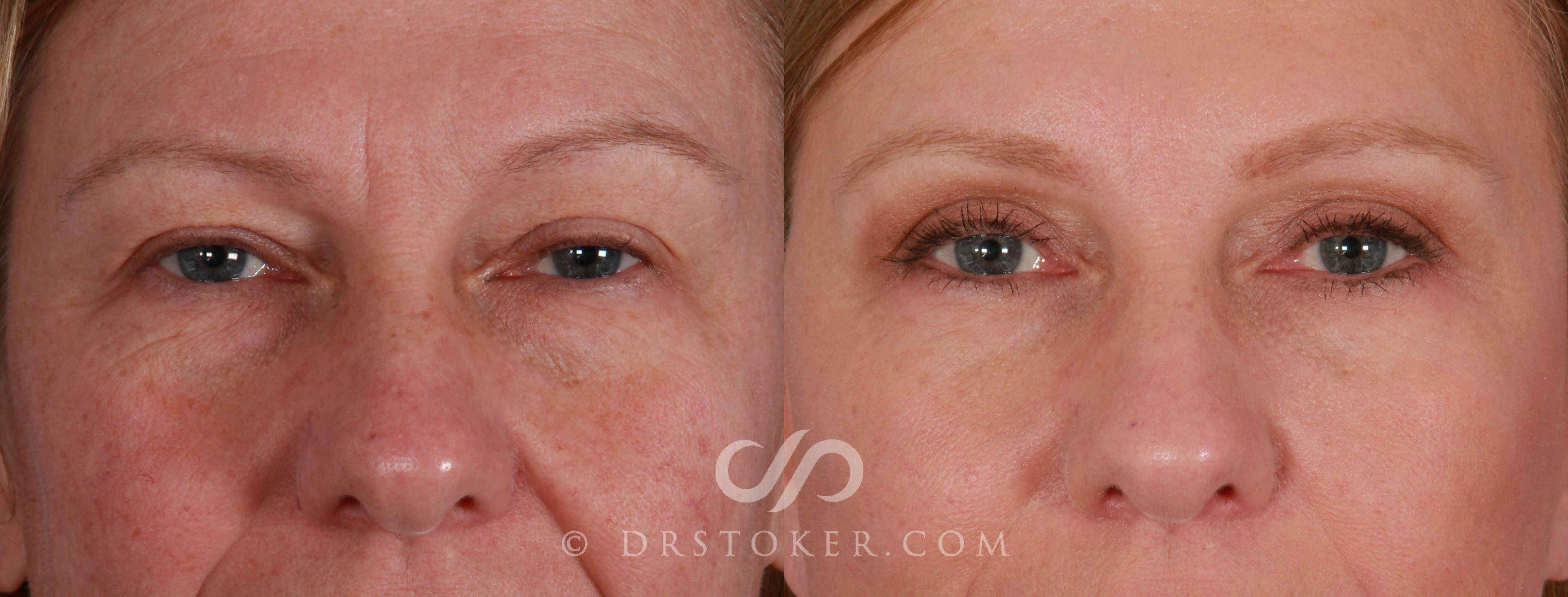 Before & After Eyelid Surgery Case 844 View #1 View in Los Angeles, CA