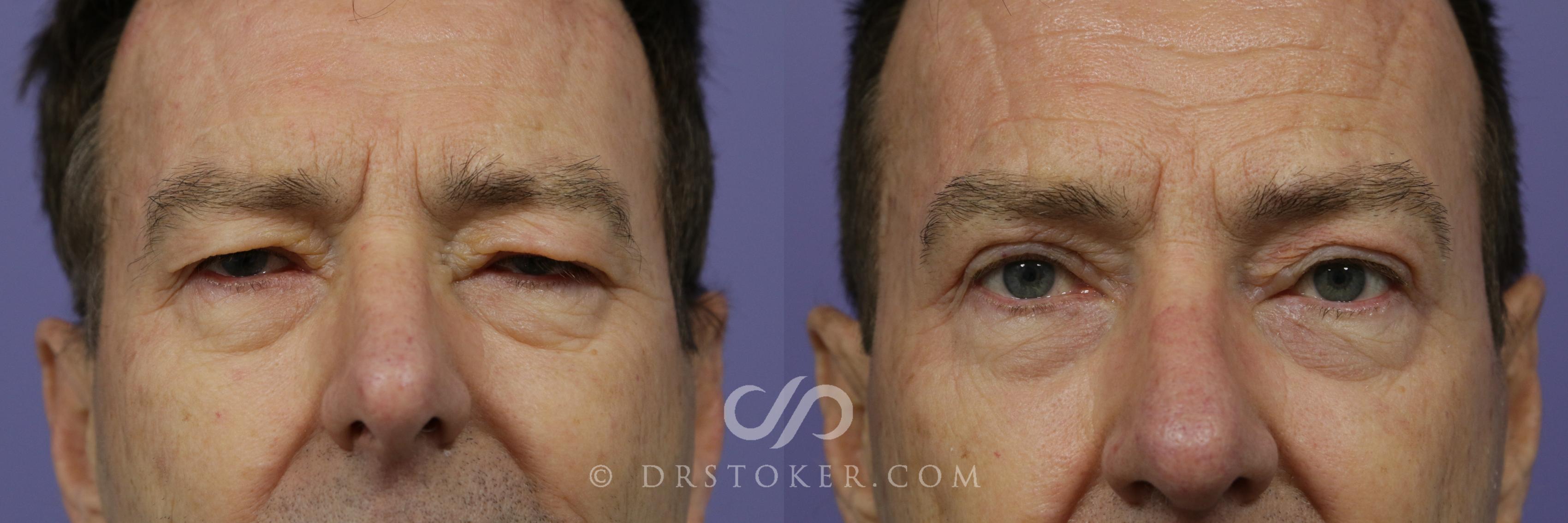 Before & After Eyelid Surgery Case 845 View #1 View in Los Angeles, CA