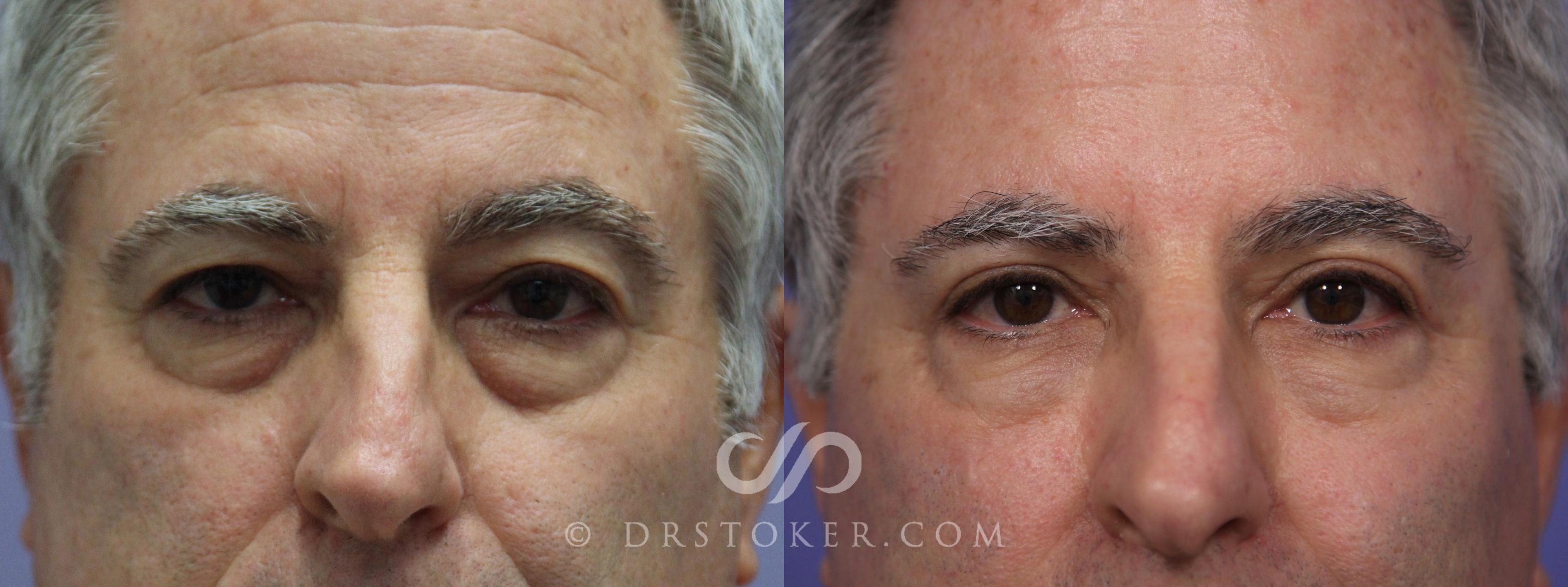 Before & After Eyelid Surgery for Men Case 847 View #1 View in Marina del Rey, CA