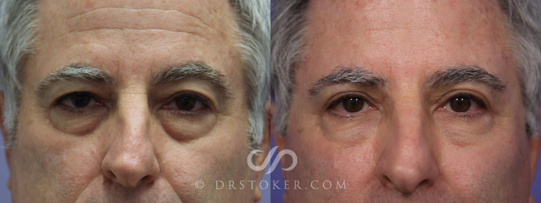 Before & After Eyelid Surgery Case 847 View #1 View in Los Angeles, CA