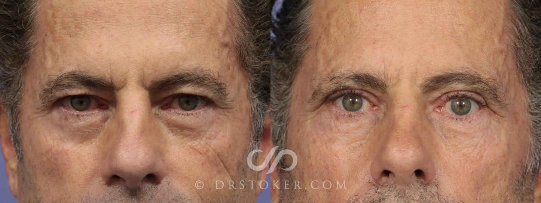 Before & After Eyelid Surgery for Men Case 849 View #1 View in Los Angeles, CA