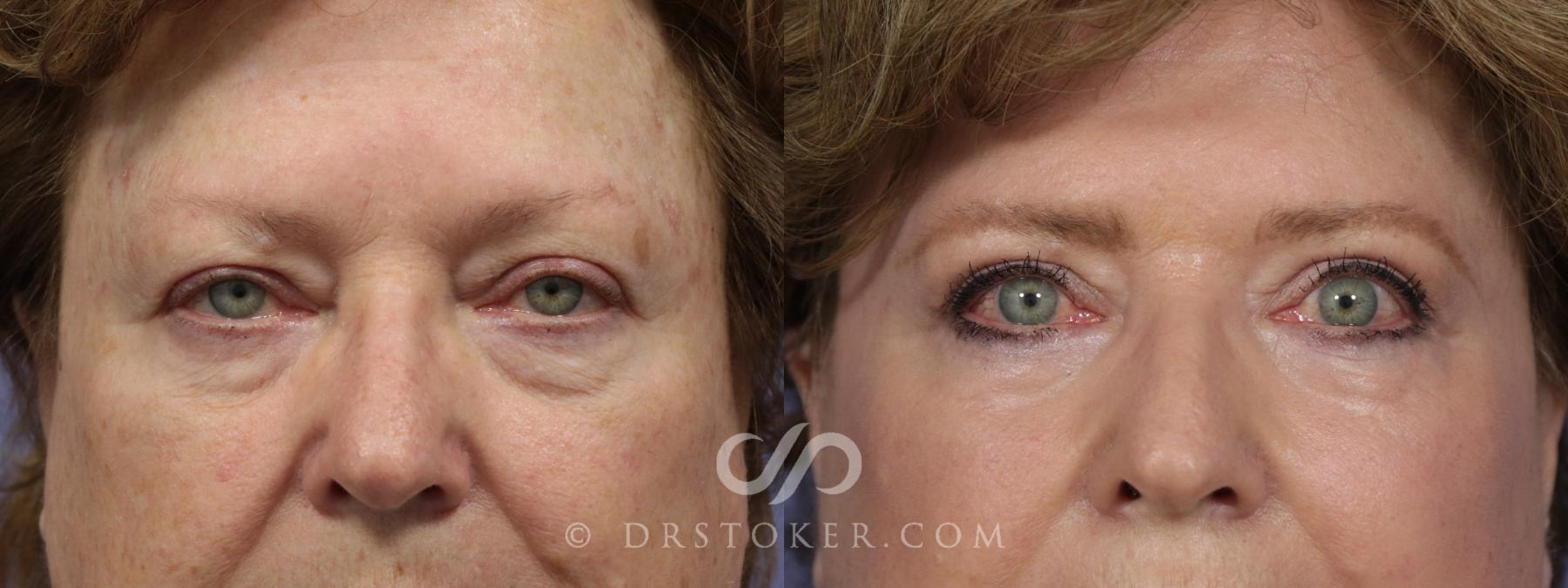 Before & After Eyelid Surgery Case 850 View #1 View in Los Angeles, CA