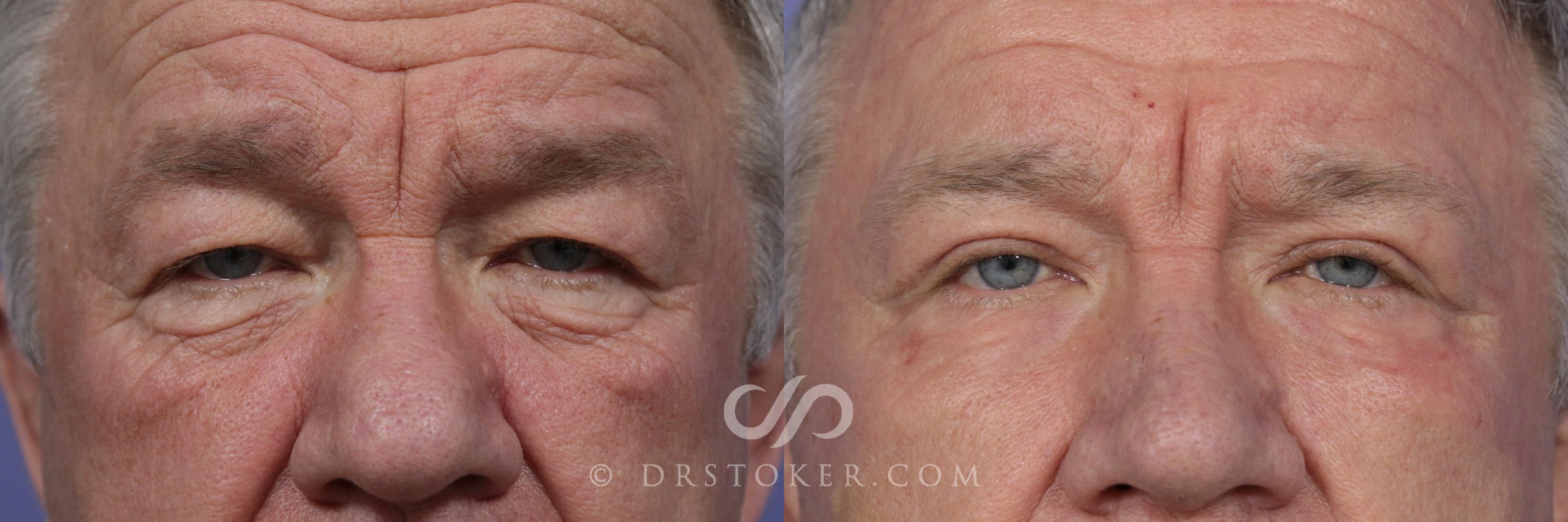 Before & After Eyelid Surgery for Men Case 851 View #1 View in Marina del Rey, CA