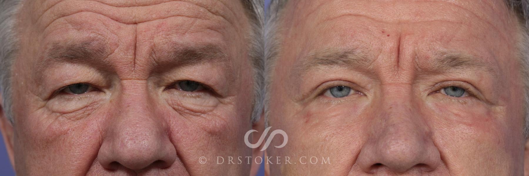 Before & After Eyelid Surgery Case 851 View #1 View in Los Angeles, CA