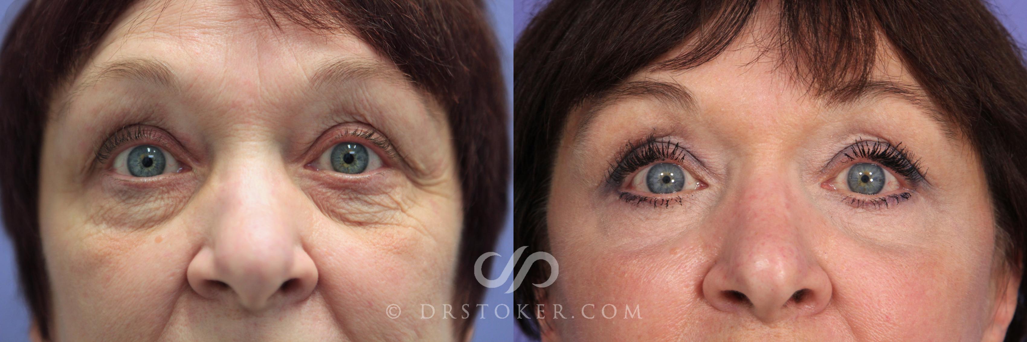 Before & After Eyelid Surgery Case 852 View #1 View in Los Angeles, CA