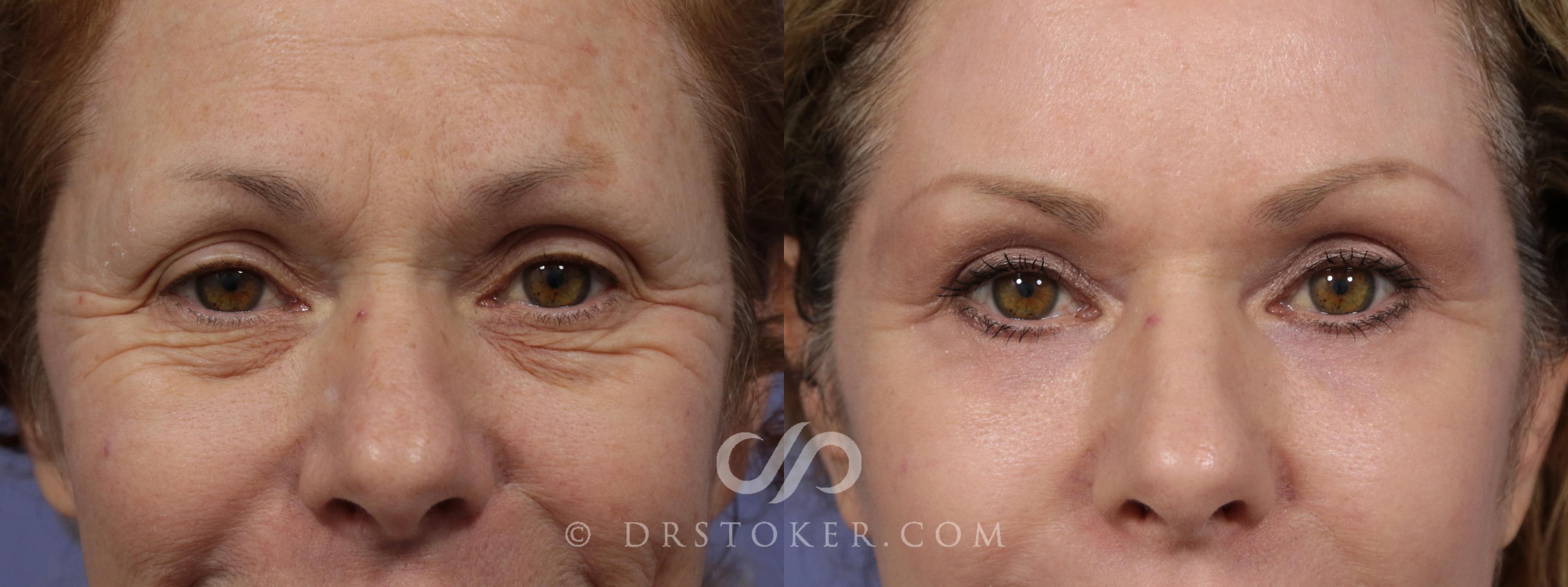Before & After Eyelid Surgery Case 853 View #1 View in Los Angeles, CA