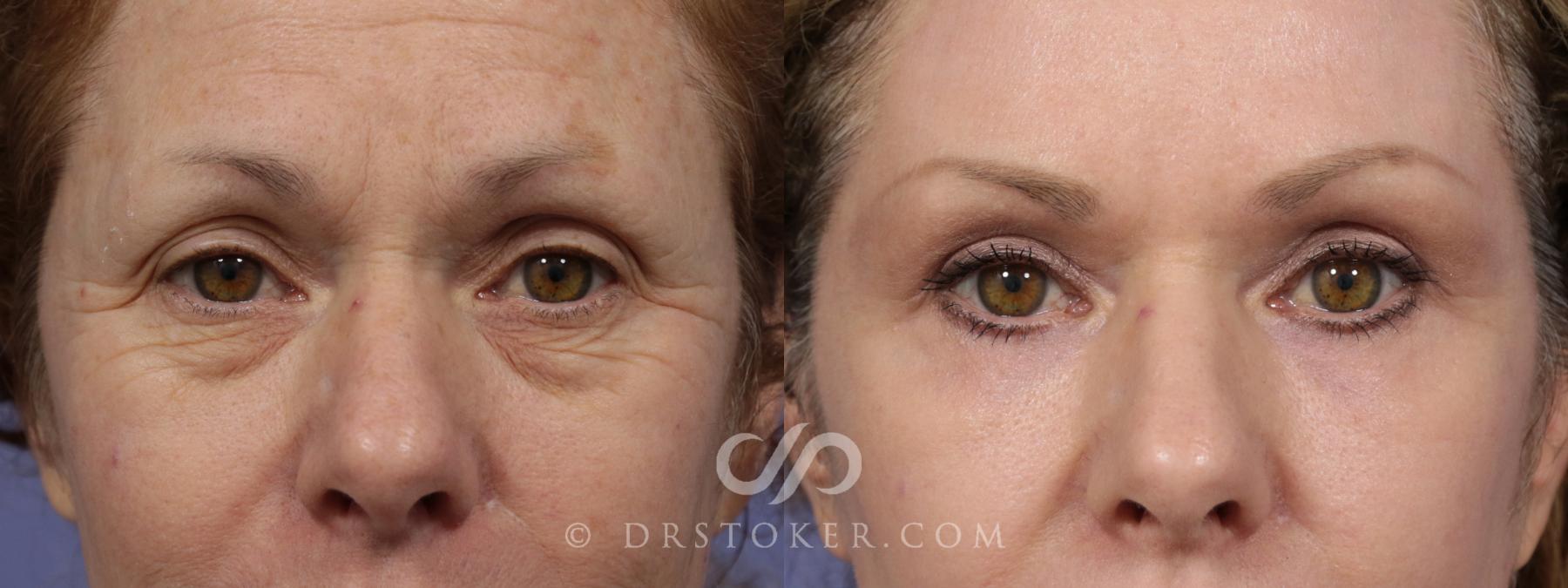 Before & After Eyelid Surgery Case 854 View #1 View in Los Angeles, CA