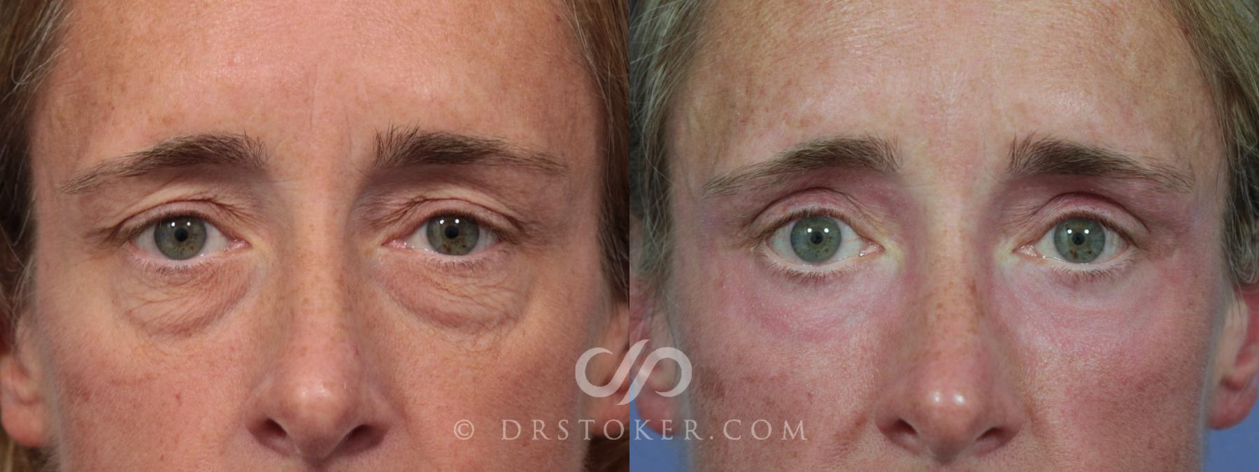 Before & After Eyelid Surgery Case 855 View #1 View in Los Angeles, CA