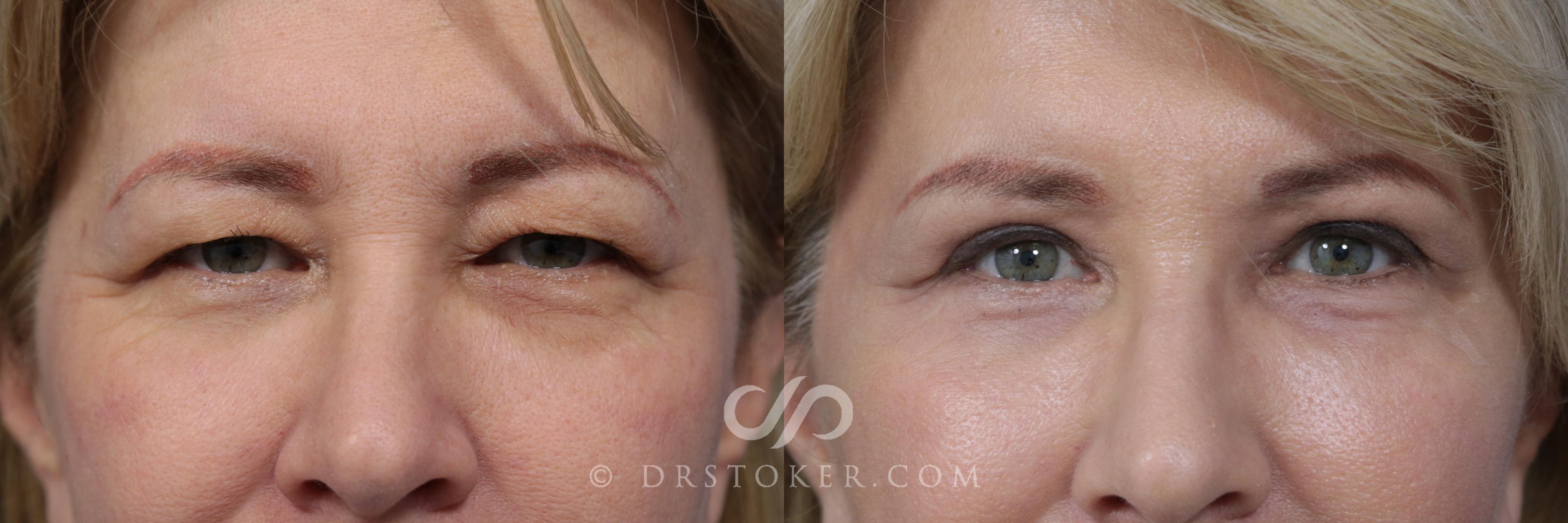 Before & After Eyelid Surgery Case 856 View #1 View in Los Angeles, CA