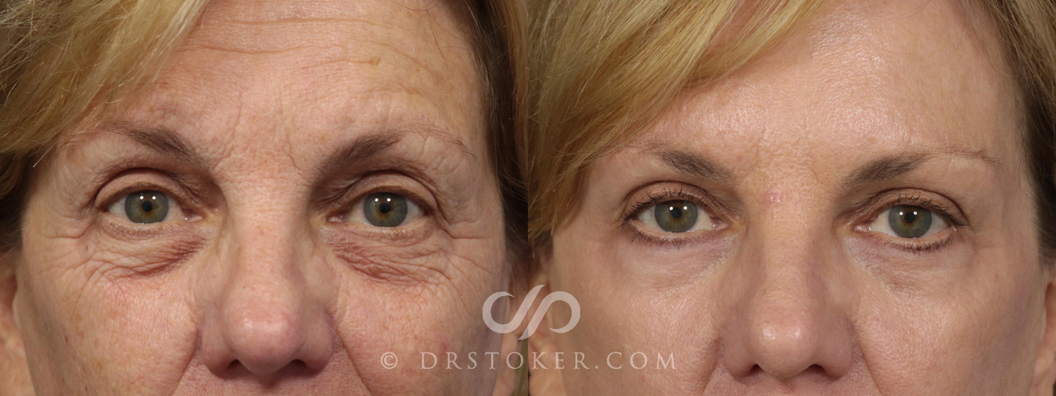 Before & After Eyelid Surgery Case 857 View #1 View in Los Angeles, CA