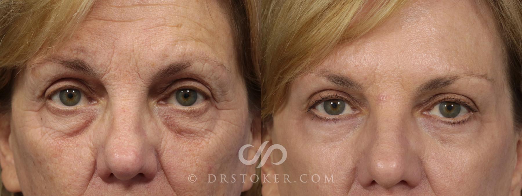 Before & After Eyelid Surgery Case 858 View #1 View in Los Angeles, CA