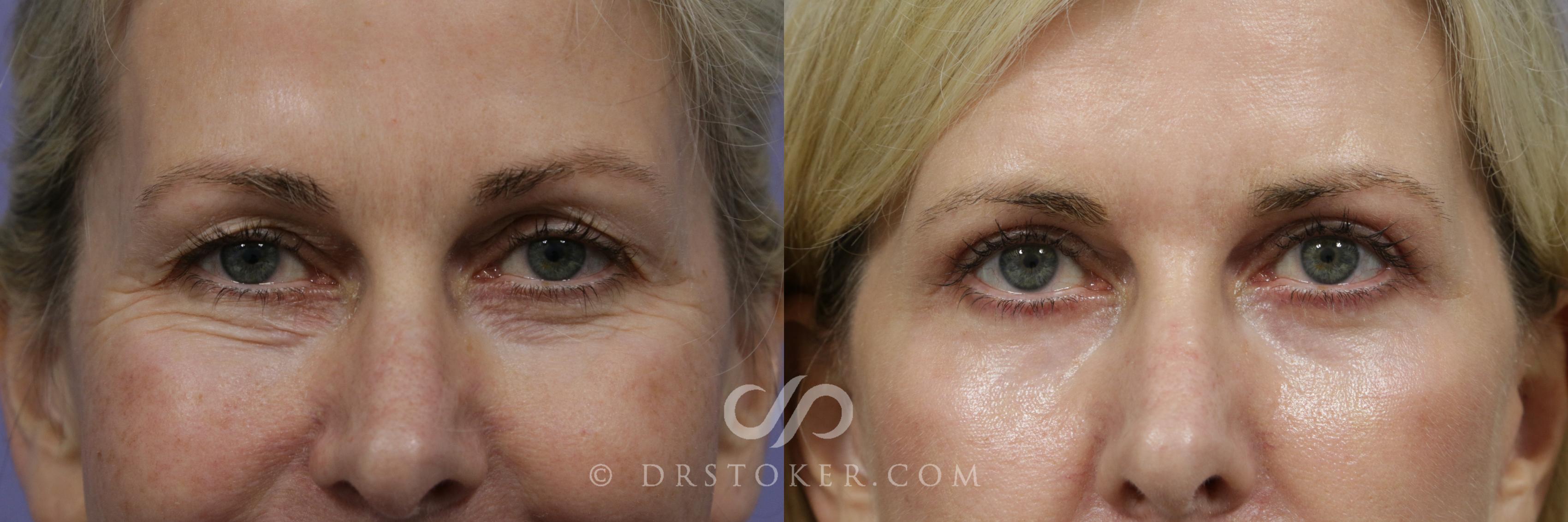 Before & After Eyelid Surgery Case 860 View #1 View in Los Angeles, CA