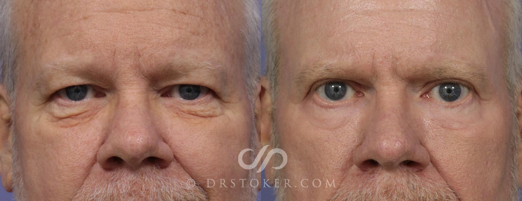 Before & After Eyelid Surgery for Men Case 861 View #1 View in Los Angeles, CA