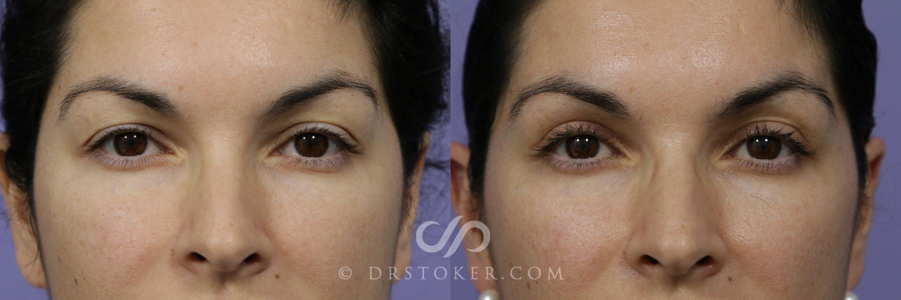 Before & After Eyelid Surgery Case 862 View #1 View in Los Angeles, CA