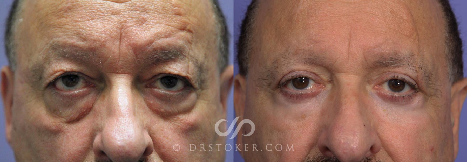 Before & After Eyelid Surgery Case 863 View #1 View in Los Angeles, CA