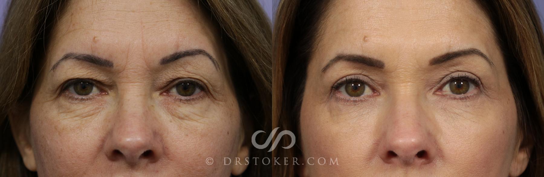 Before & After Eyelid Surgery Case 864 View #1 View in Los Angeles, CA