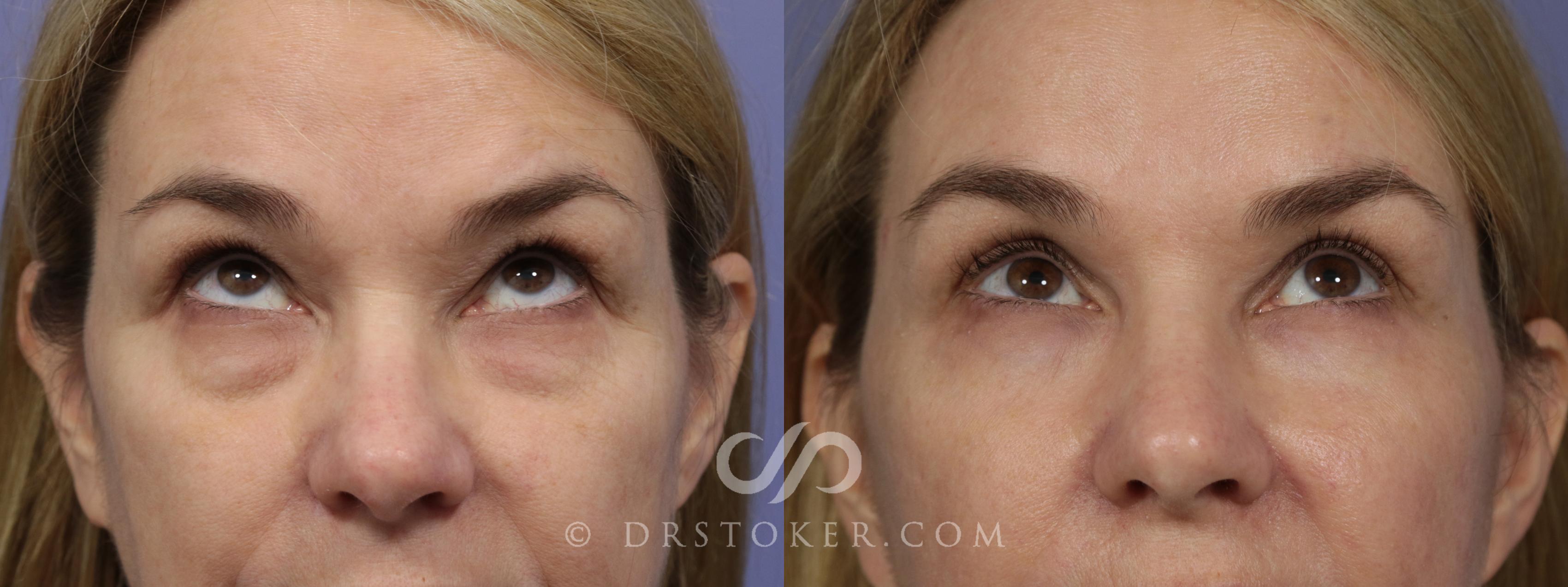 Before & After Eyelid Surgery Case 867 View #1 View in Los Angeles, CA