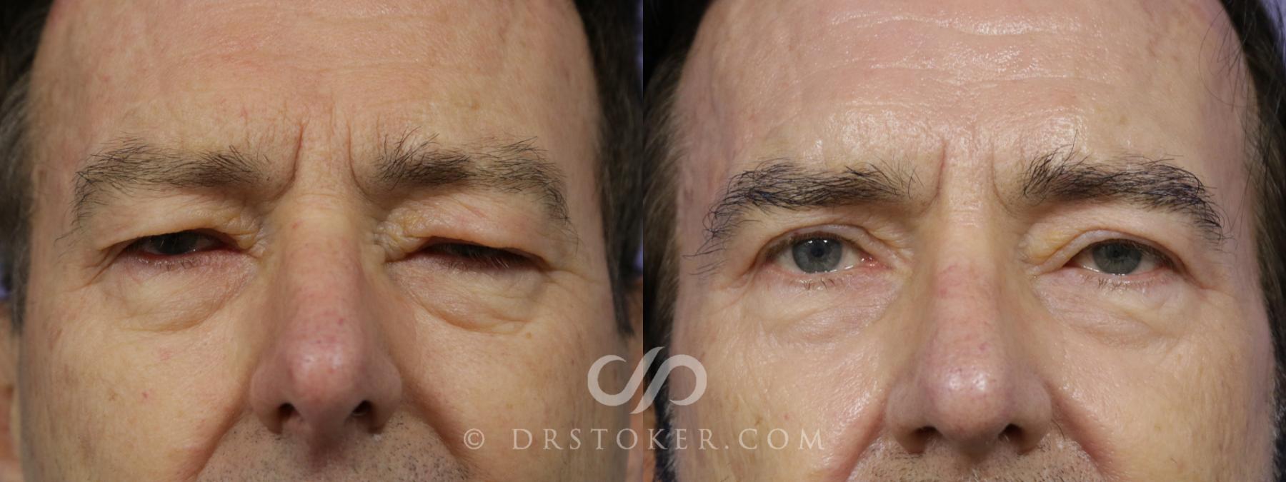 Before & After Eyelid Surgery for Men Case 1474 View #1 View in Los Angeles, CA