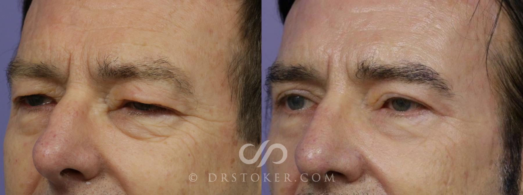 Before & After Eyelid Surgery for Men Case 1474 View #2 View in Los Angeles, CA