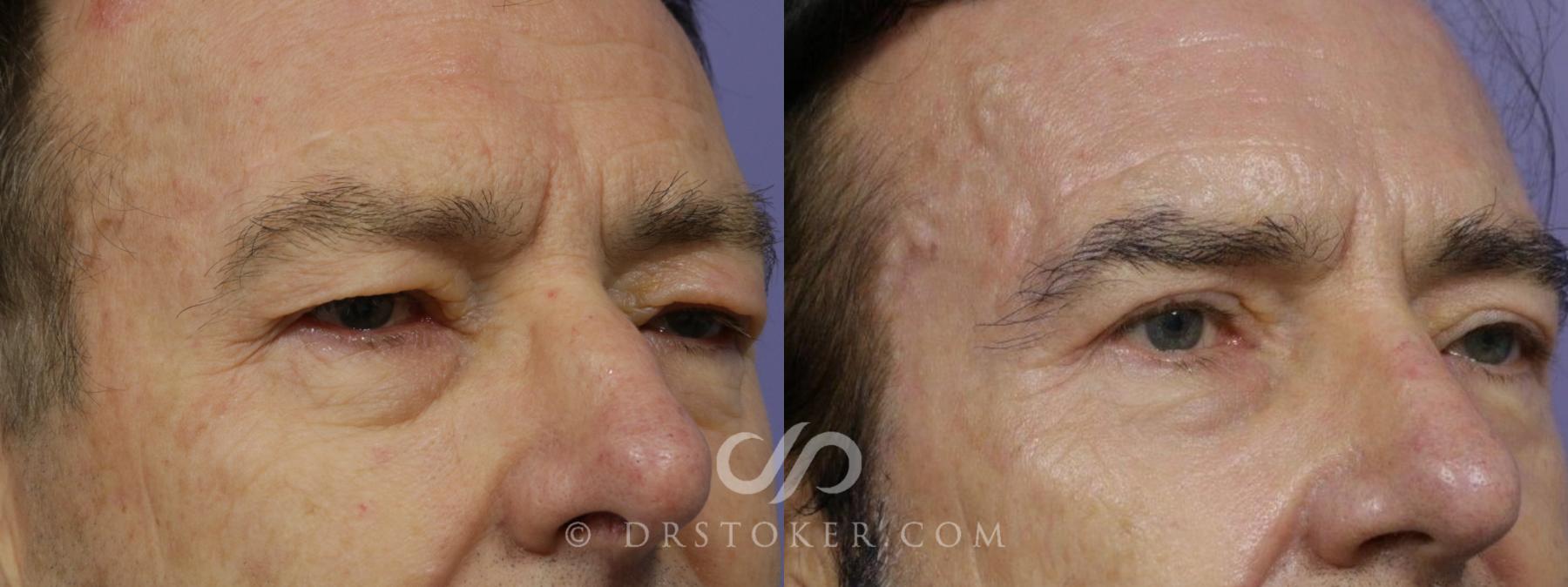 Before & After Eyelid Surgery for Men Case 1474 View #3 View in Los Angeles, CA