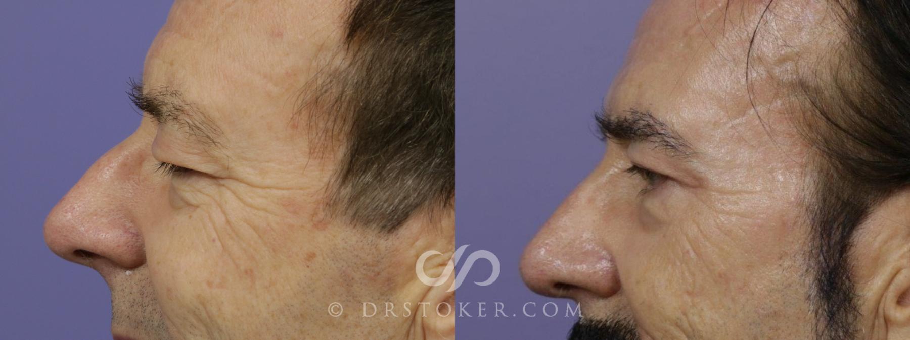 Before & After Eyelid Surgery for Men Case 1474 View #4 View in Los Angeles, CA