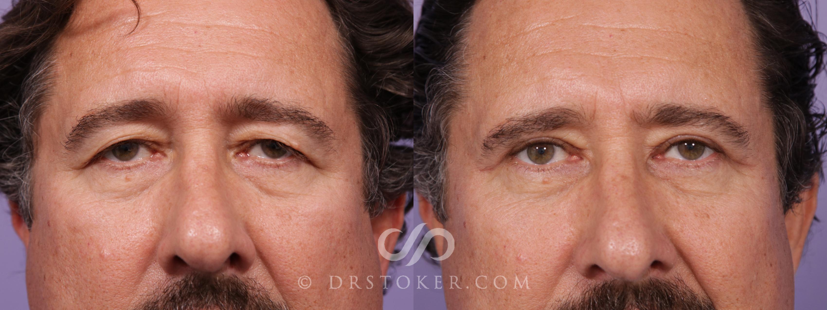 Before & After Eyelid Surgery for Men Case 1774 View #1 View in Los Angeles, CA