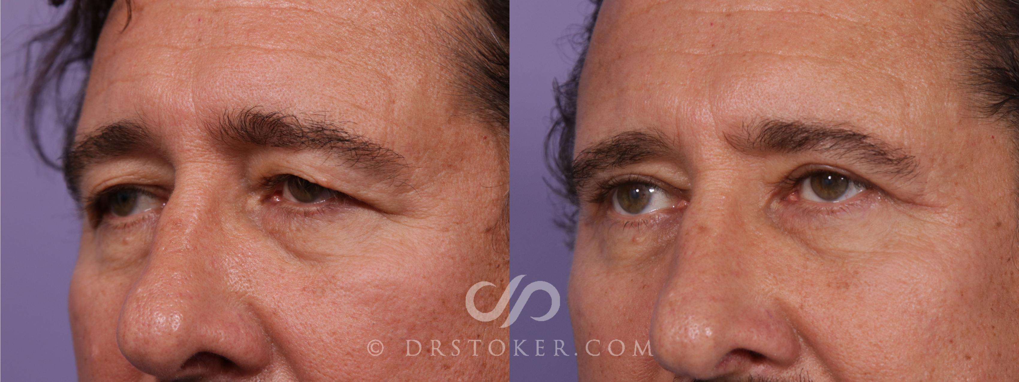 Before & After Eyelid Surgery for Men Case 1774 View #2 View in Los Angeles, CA