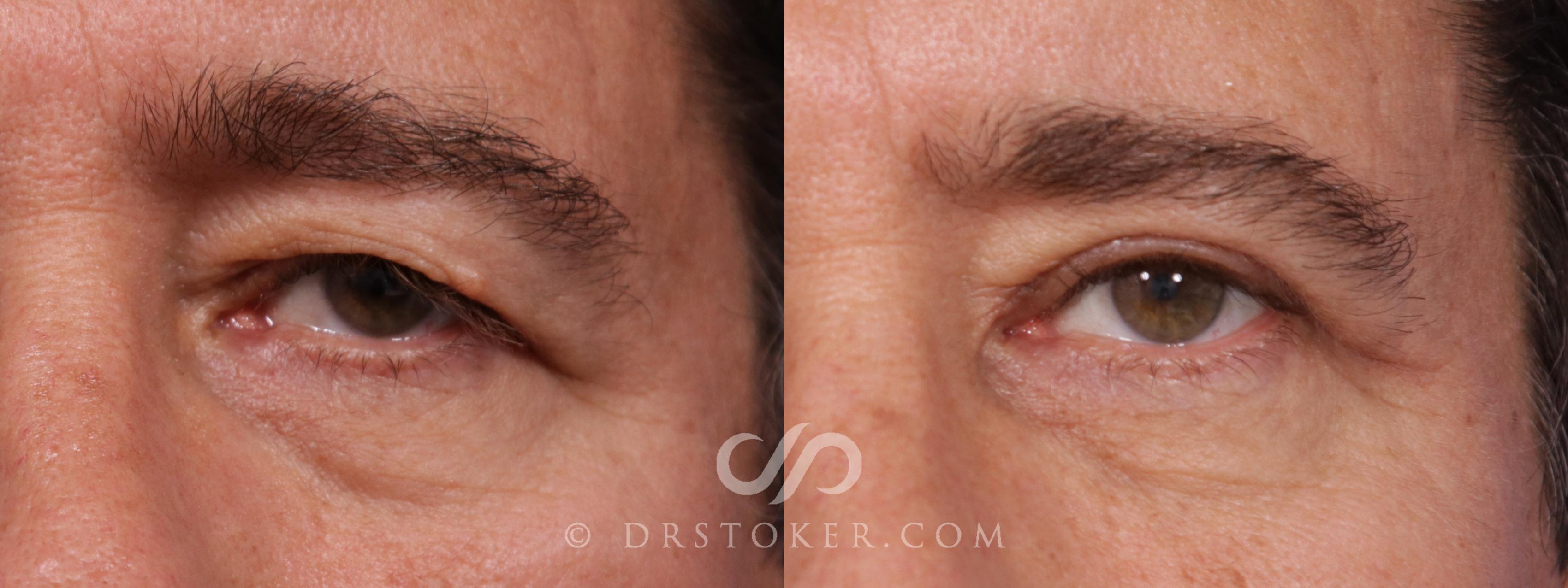 Before & After Eyelid Surgery for Men Case 1775 View #1 View in Los Angeles, CA