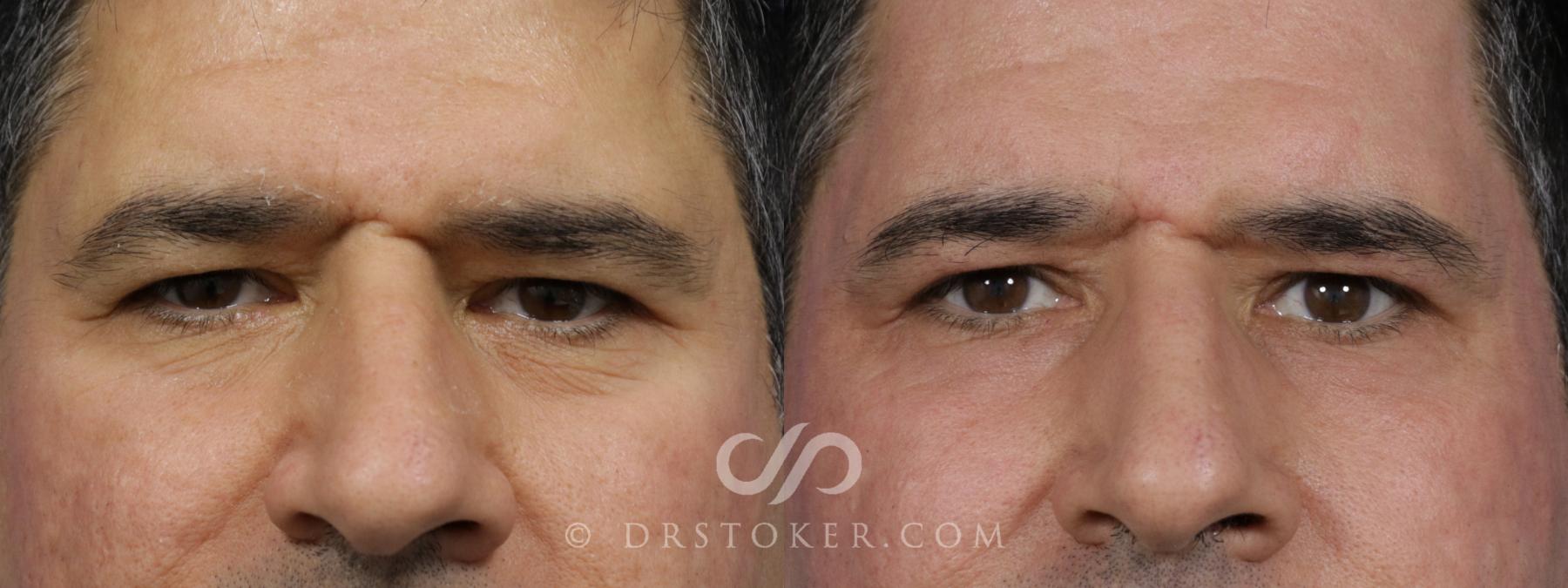 Before & After Eyelid Surgery Case 1777 View #1 View in Los Angeles, CA