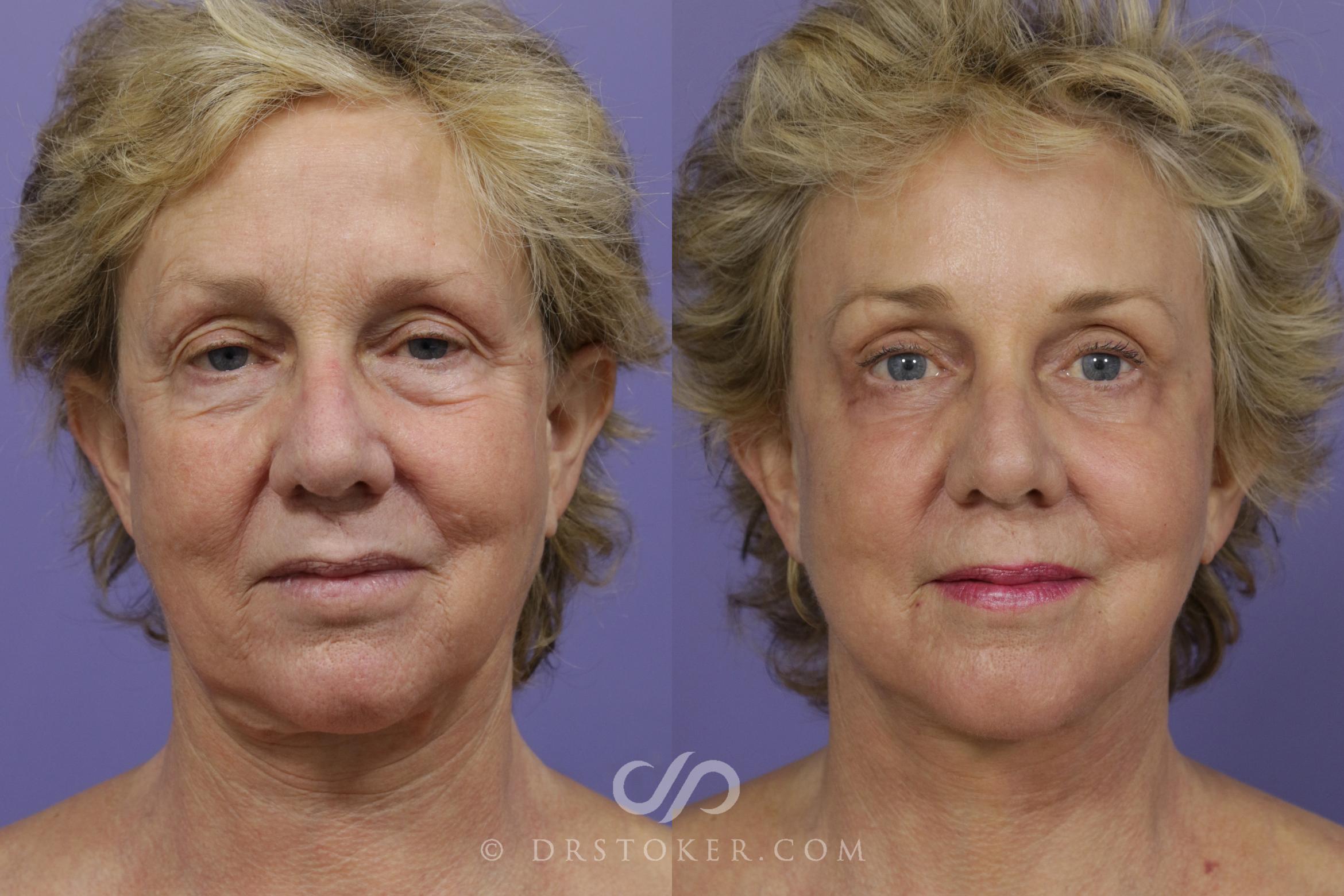 Before & After Facelift - Traceless Facelift Case 1298 View #1 View in Los Angeles, CA