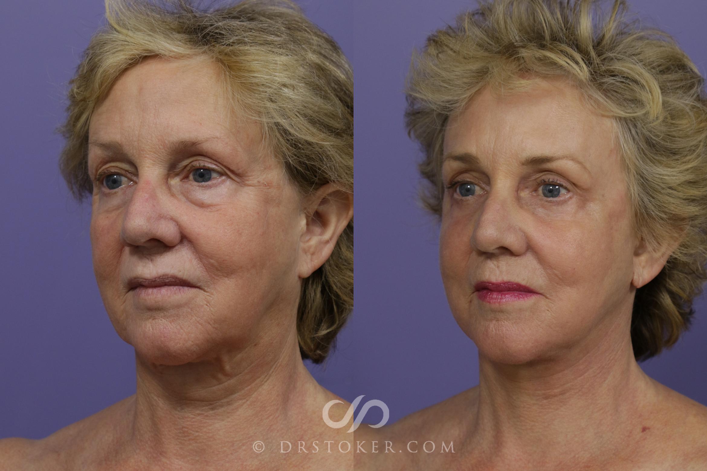 Before & After Facelift - Traceless Facelift Case 1298 View #2 View in Los Angeles, CA