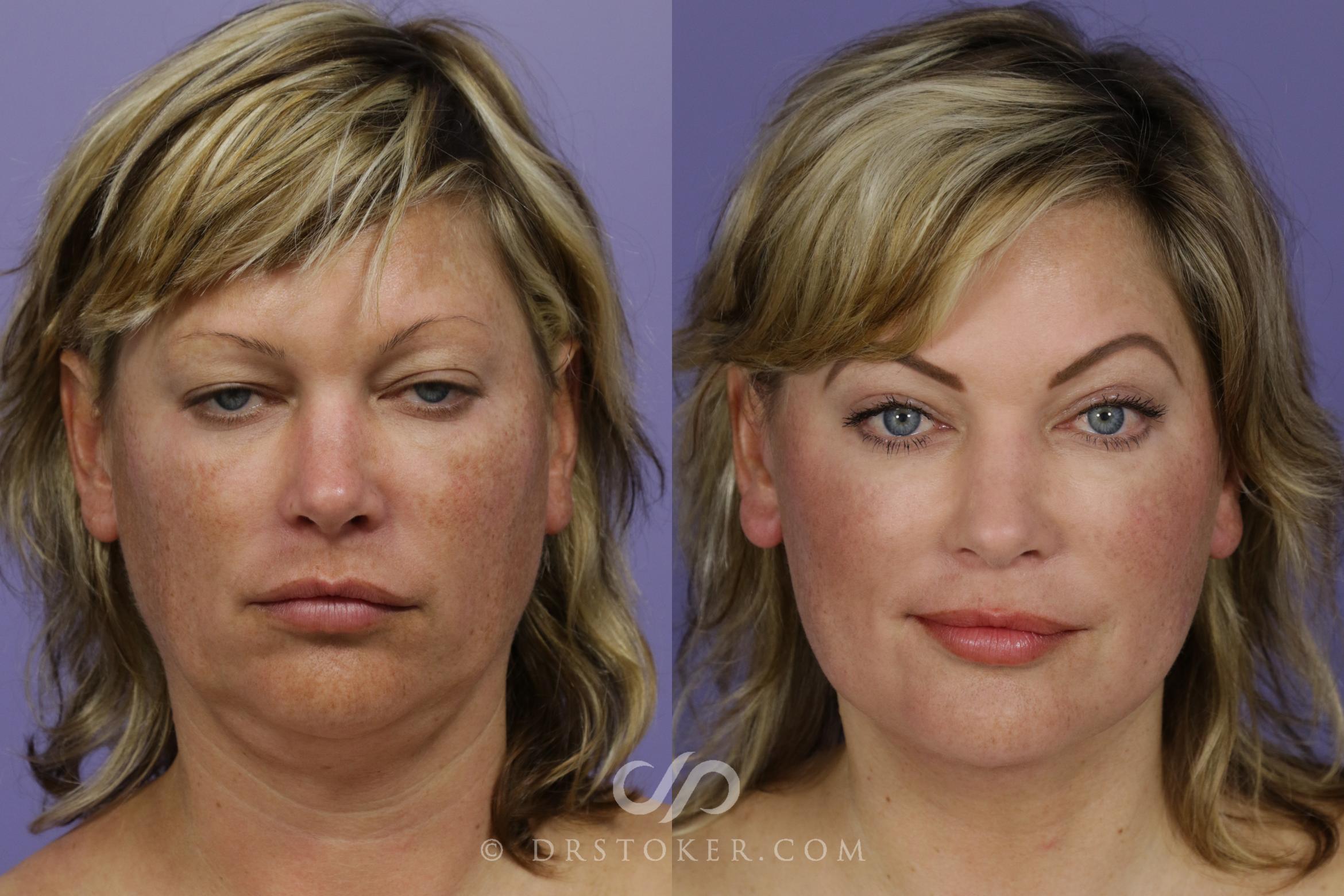 Before & After Facelift - Traceless Facelift Case 1299 View #1 View in Los Angeles, CA
