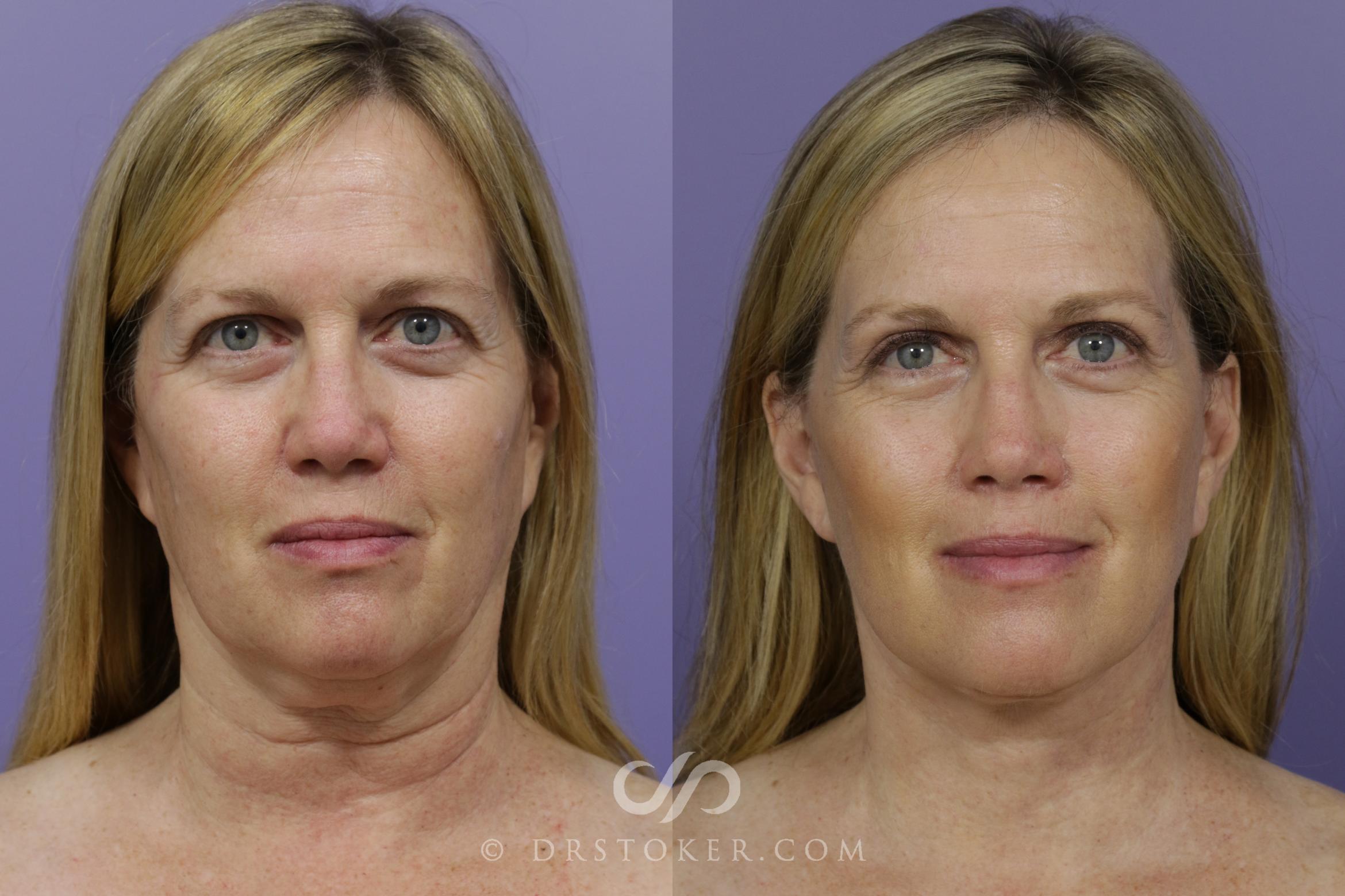 Before & After Fat Grafting Case 1469 View #1 View in Los Angeles, CA