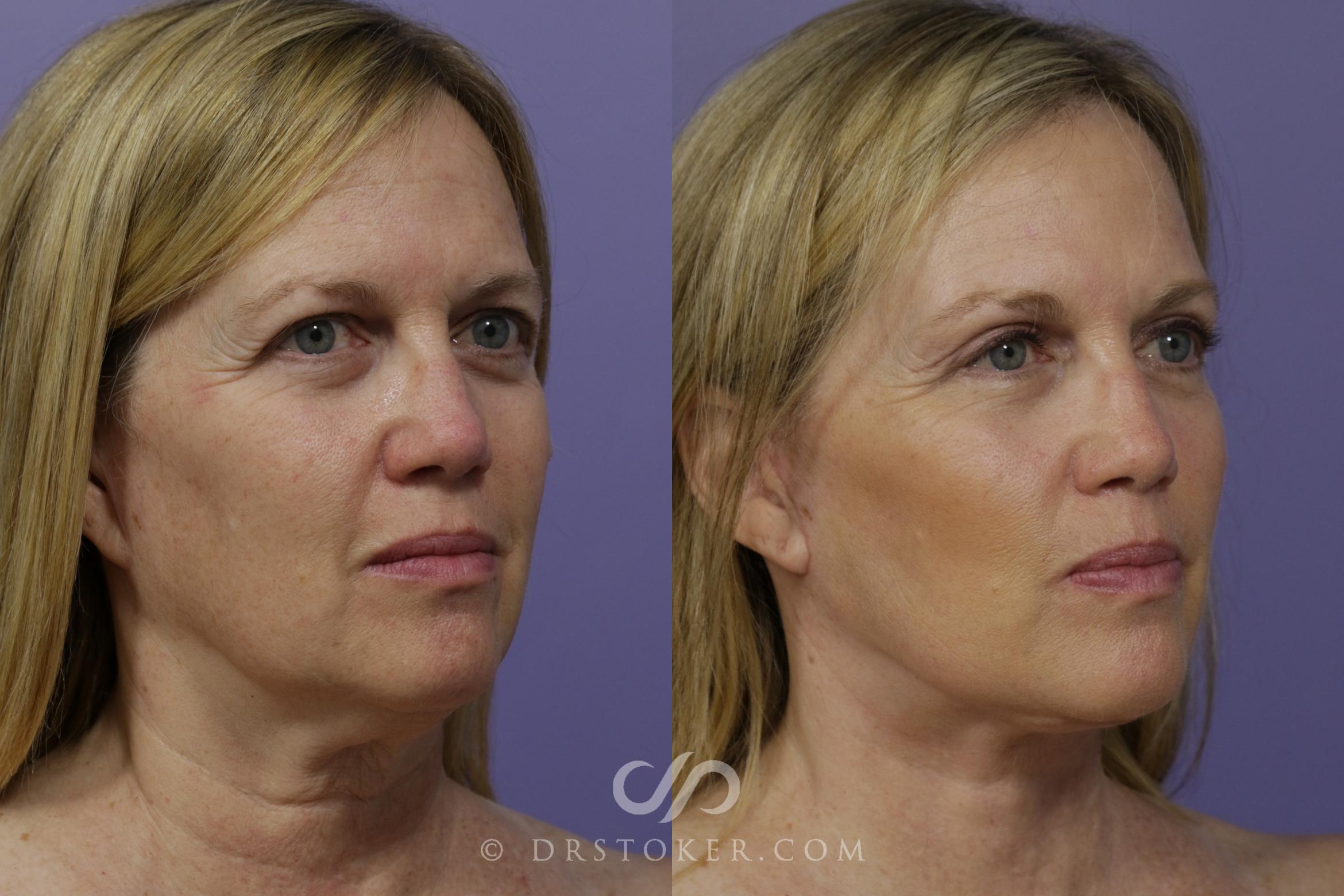 Before & After Facelift - Traceless Facelift Case 1469 View #2 View in Los Angeles, CA