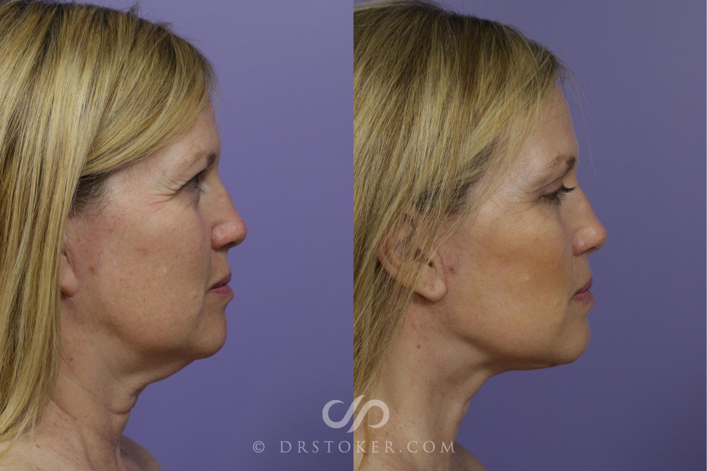 Before & After Facelift - Traceless Facelift Case 1469 View #3 View in Los Angeles, CA
