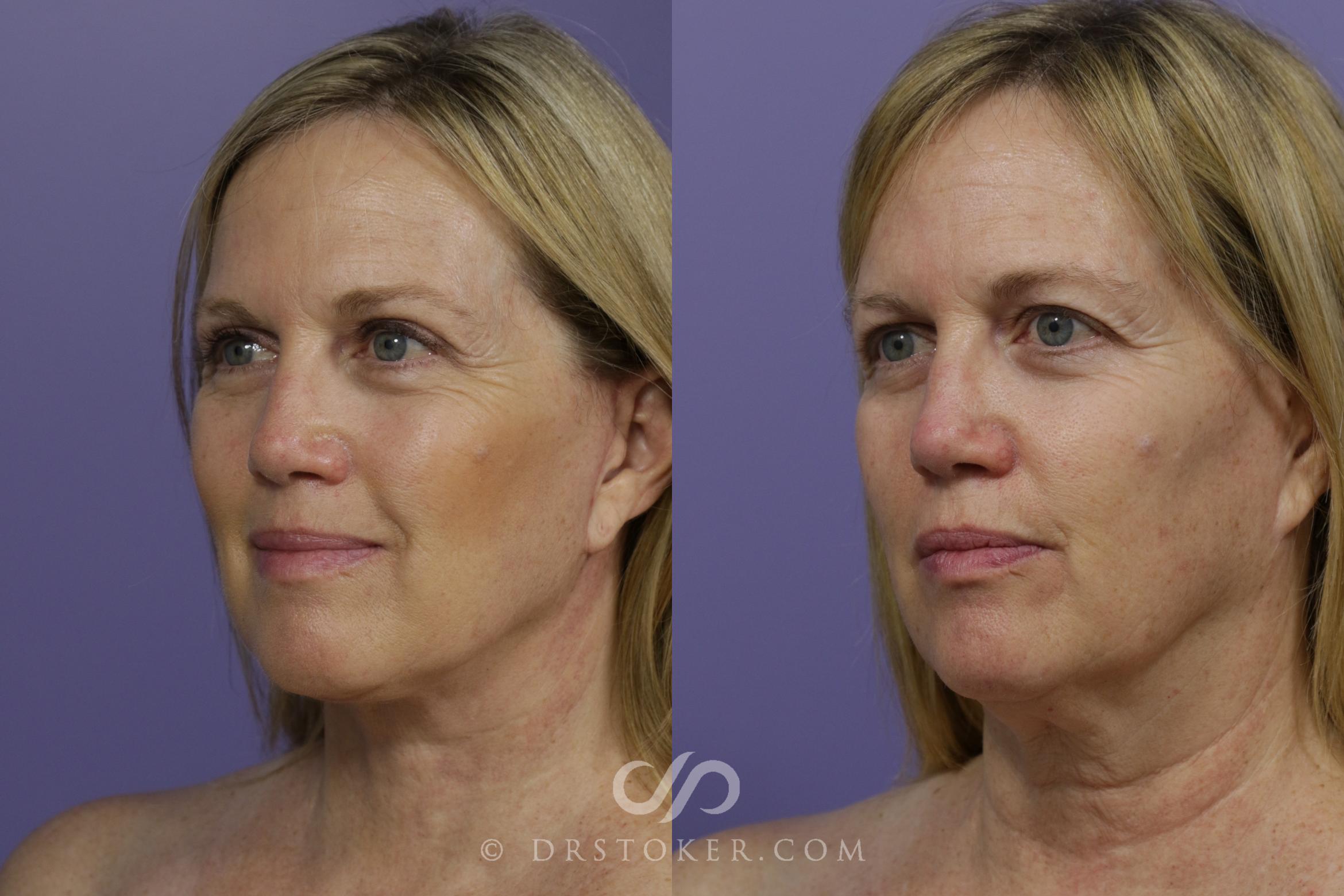 Before & After Facelift - Traceless Facelift Case 1469 View #4 View in Los Angeles, CA
