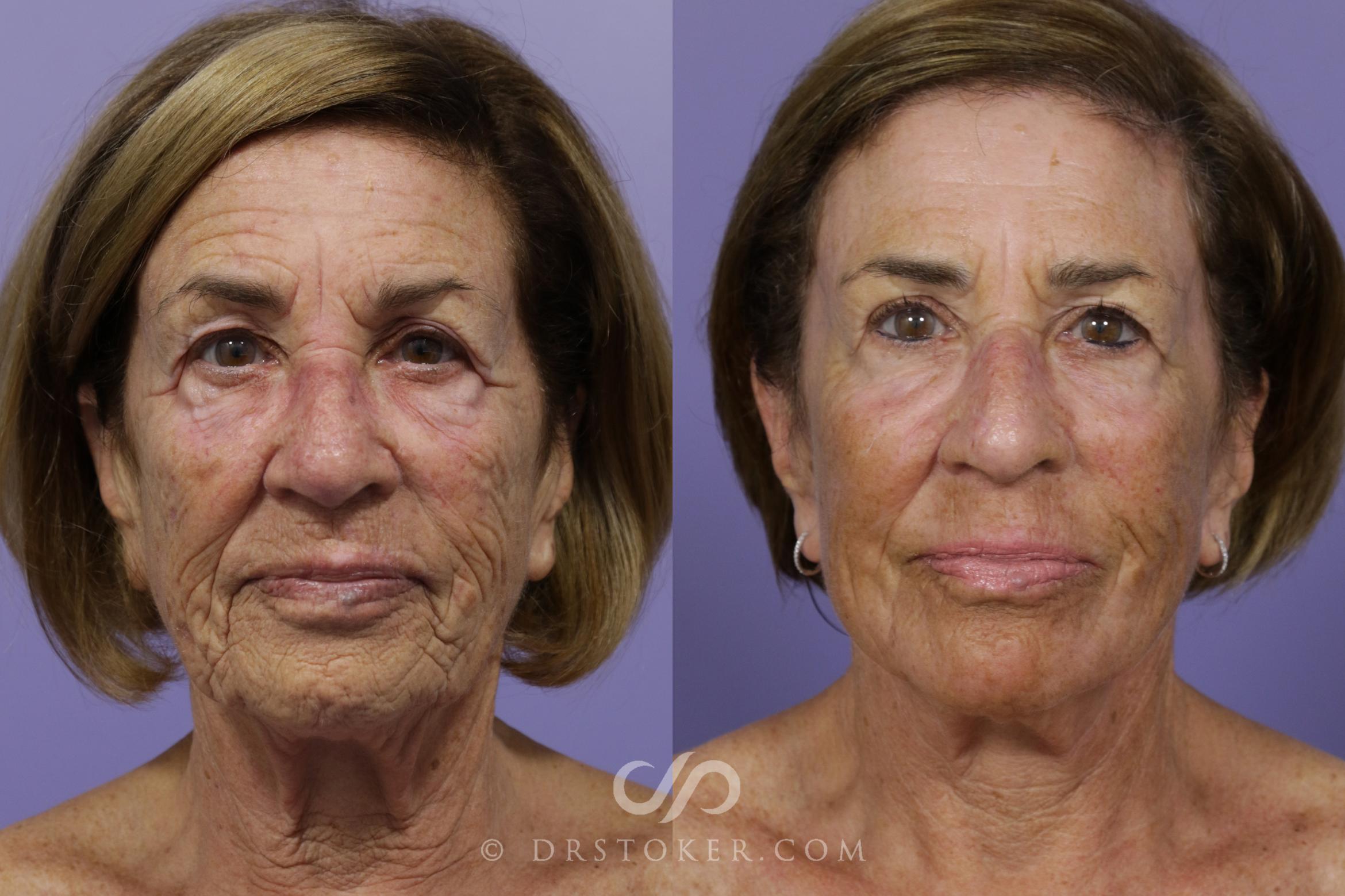 Before & After Laser Resurfacing  Case 1535 View #1 View in Marina del Rey, CA